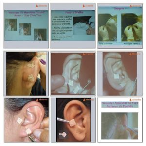 Curso Presencial Auriculoterapia e Auriculomedicina