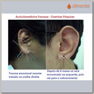 Curso Presencial de Auriculoterapia e AuriculoMedicina Francesa