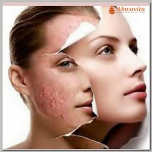 Tratamento Anti Acne com Laser e Peeling