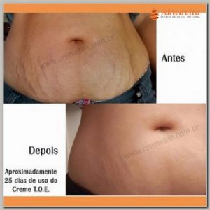 Estrias Flacidez Celulite com Ortomolecular TOE