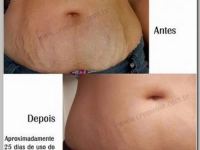 Estrias Flacidez Celulite com Ortomolecular TOE