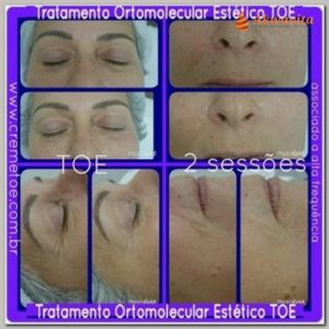 tratamento facial da flacidez com TOE