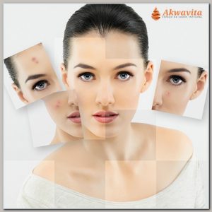 Limpeza de Pele em Acnes Cravos e Oleosidade
