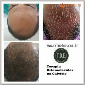 Calvície Tratamento Ortomolecular com Creme TOE