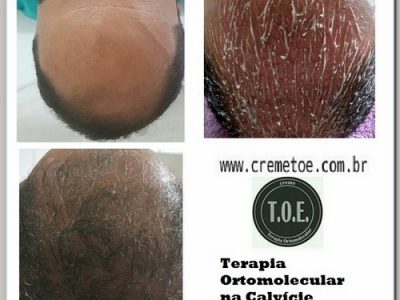 Calvície Tratamento Ortomolecular com Creme TOE