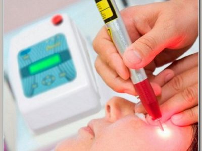 Laser em Manchas Olheiras Acnes e Rejuvenescimento