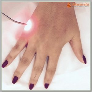 A Laserterapia na AcupunturA Laserterapia na Acupuntura Técnica Rápida e Sem Dor