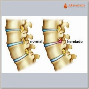 A Quiropraxia em Dores por Articulações Bloqueadas