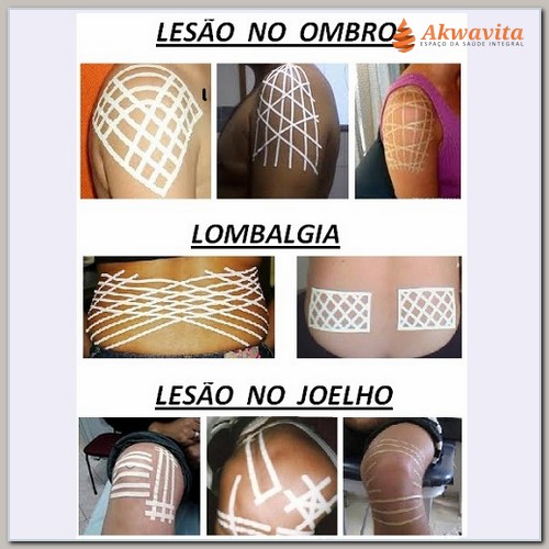 B Esparadrapoterapia Spiral e Kinesio Tira Dores